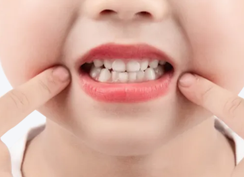 涂氟后多久能刷牙？河北惟德口腔醫(yī)生專業(yè)答疑