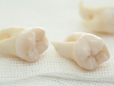 智齒疼了，這牙非拔不可嗎？