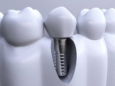 承德種植牙價(jià)格表，2024種植牙多少錢(qián)一顆呢?