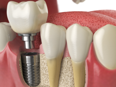 選擇種植牙后要做哪些日常維護(hù)？