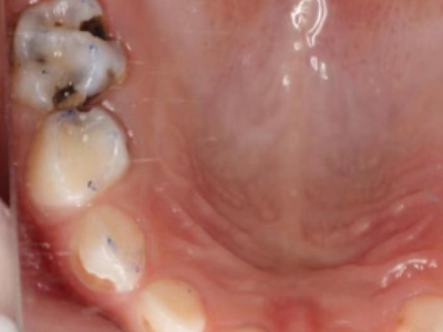 河北惟德口腔兒童涂氟，用專業(yè)守護(hù)孩子乳牙健康