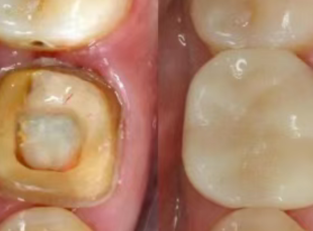 根管治療（抽神經(jīng)）后，為什么一定要做牙冠？