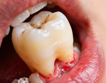 牙齒松動最佳補(bǔ)救方法