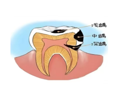 乳牙不是 “過(guò)渡品”——保護(hù)孩子牙齒從第一顆開始