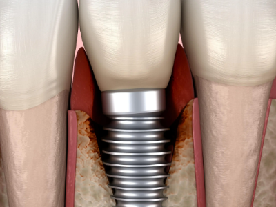 種植牙的術前準備有哪些？
