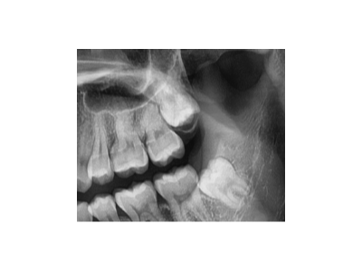 既然「智齒」不宜久留，為什么不能一次性拔掉？