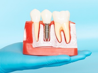 種牙VS鑲牙，你適合哪種?