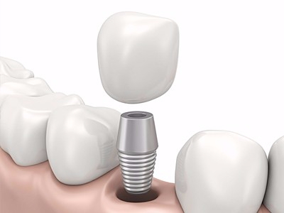 在承德哪家口腔醫(yī)院口腔種植齒好一點，惟德口腔醫(yī)院值得您的選擇