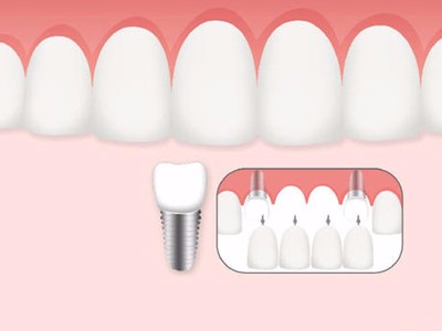 惟德口腔口腔種植怎么樣？惟德口腔就來(lái)為您一一解答
