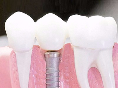 在承德口腔種植齒需要多少錢？惟德口腔一一為您道來