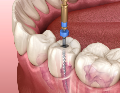 根管治療后的注意事項(xiàng)有哪些？