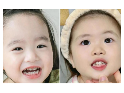 河北惟德口腔涂氟太貼心，孩子不抗拒，家長更省心